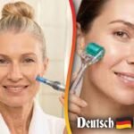 Microneedling zuhause